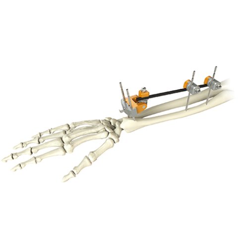 Ulna & Radius External Fixator