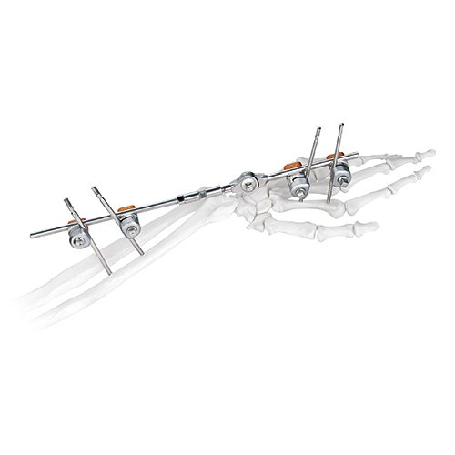 Wrist Joint External Fixator