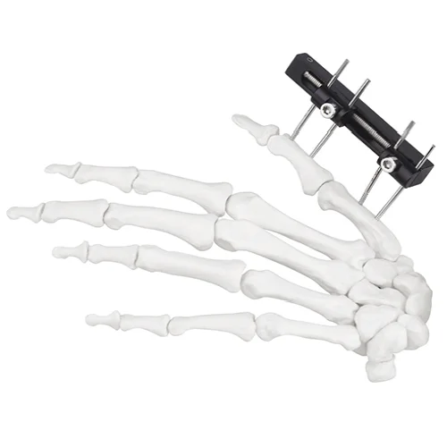 Mini Fragment External Fixator (Finger and Palm)