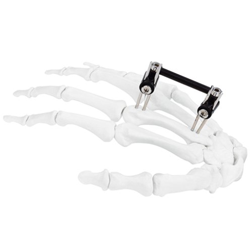 Mini Fragment External Fixator (Finger and Palm)