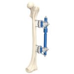 Femoral External Fixator