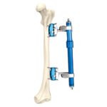 Femoral External Fixator