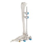 Ankle Joint External Fixator