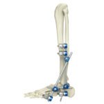 Ankle Joint External Fixator
