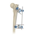 Proximal Femur External Fixator