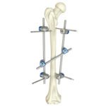 Femoral Shaft External Fixator
