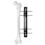 Bone Lengthening External Fixator - Type B