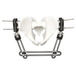 Pelvic Fragment External Fixator - Type A