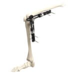 Knee Joint External Fixator