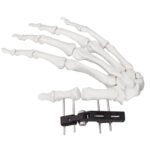 Mini Fragment External Fixator (Finger and Palm)