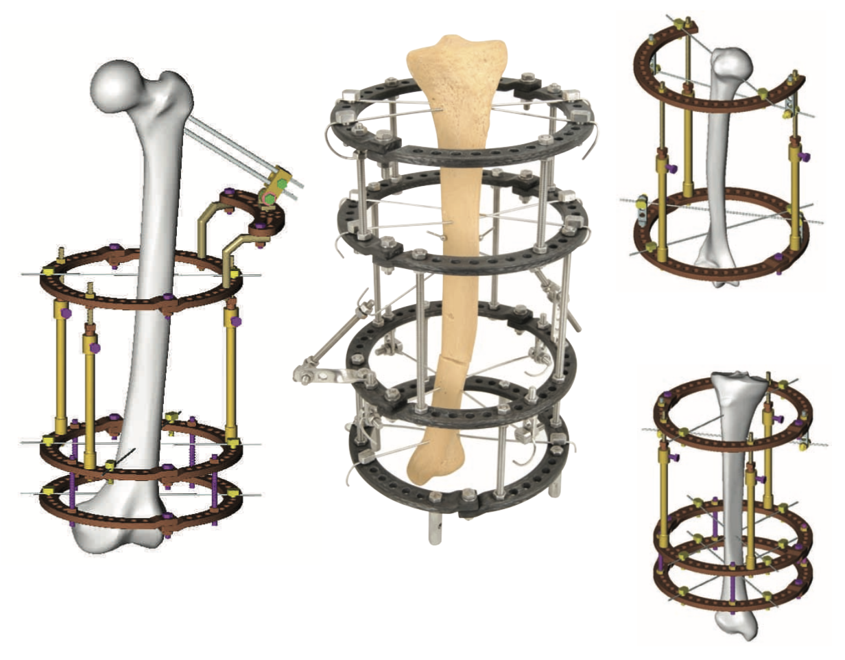 orthopromed ilizarov external fixator