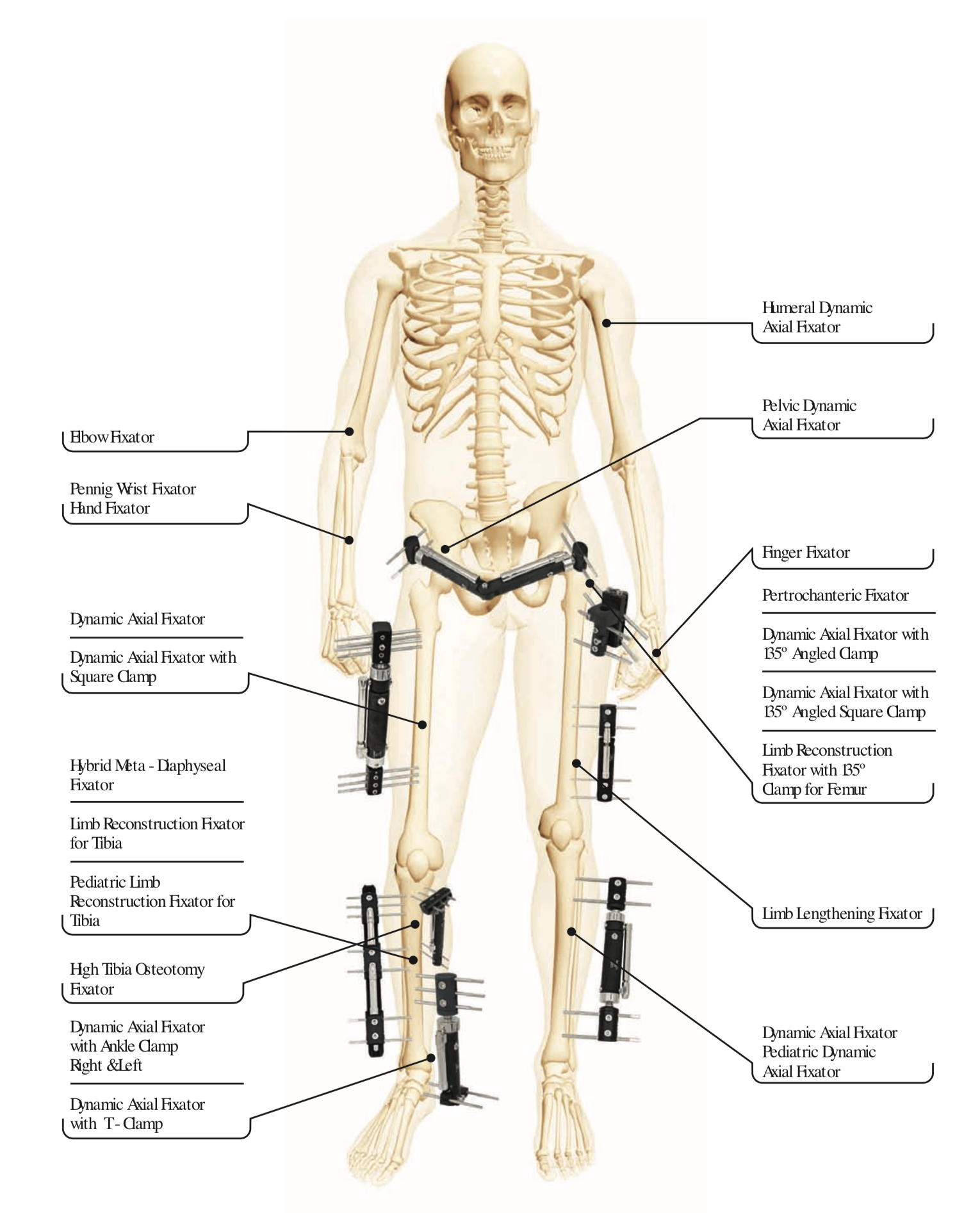 TIBIA BY HYBRID FIXATION